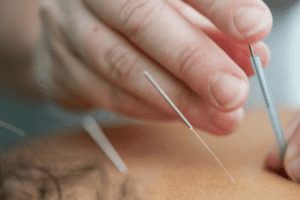 Cómo la acupuntura puede ayudar a reducir la ansiedad y el estrés