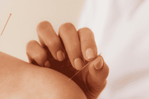 analgesia por acupuntura